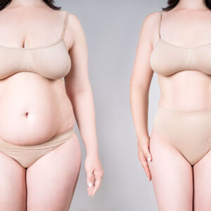 A before-and-after comparison of a woman in nude-colored underwear, showing a significant transformation in body shape, illustrating the results a mommy makeover include, such as a tummy tuck, liposuction, and breast enhancement for post-pregnancy body restoration.