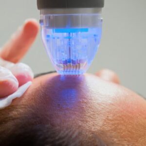 RF microneedling device with blue radiofrequency energy treating forehead area by practitioner in gloves, demonstrating Morpheus8 technology requiring proper recovery protocols