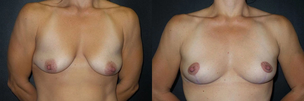 Real Patient Results in Newport Beach, CA. Preformed by Semira Bayait, MD, FACS.
