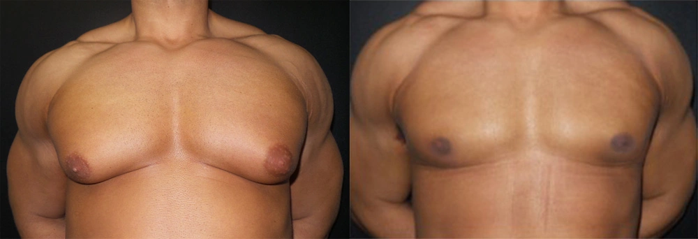Real Patient Results in Newport Beach, CA. Preformed by Semira Bayait, MD, FACS.