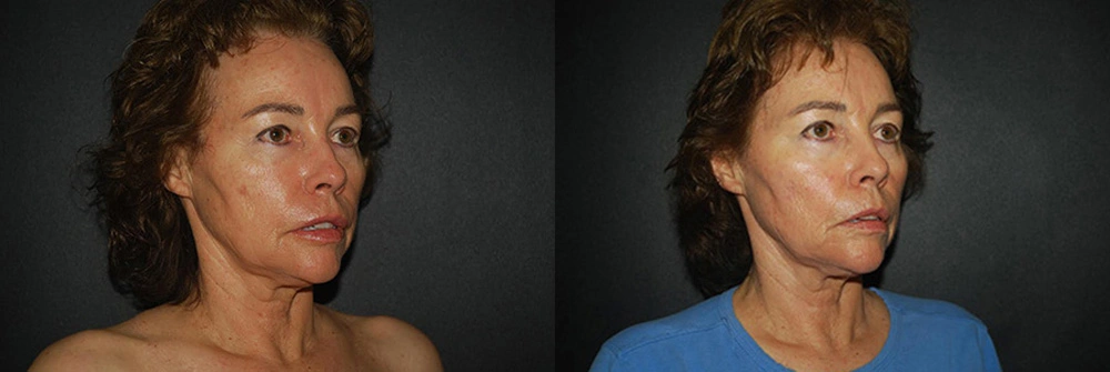Real Patient Results in Newport Beach, CA. Preformed by Semira Bayait, MD, FACS.