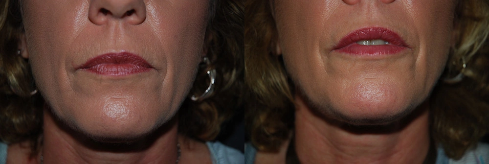 Real Patient Results in Newport Beach, CA. Preformed by Semira Bayait, MD, FACS.