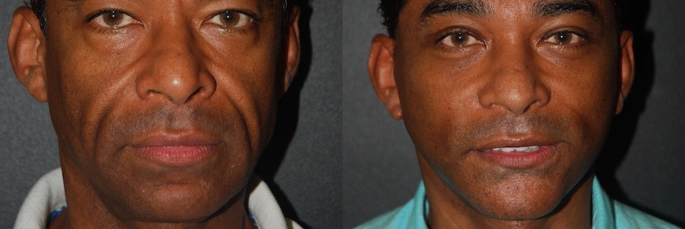 Real Patient Results in Newport Beach, CA. Preformed by Semira Bayait, MD, FACS.