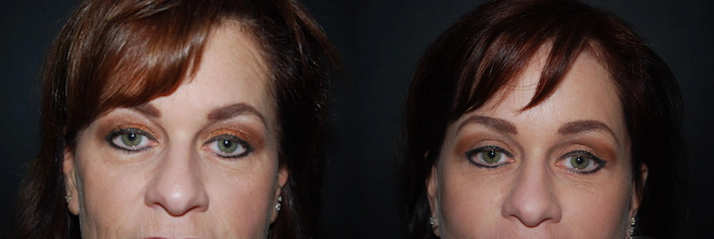 Real Patient Results in Newport Beach, CA. Preformed by Semira Bayait, MD, FACS.