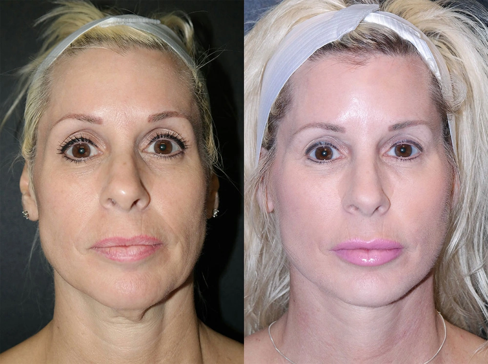 Real Patient Results in Newport Beach, CA. Preformed by Semira Bayait, MD, FACS.