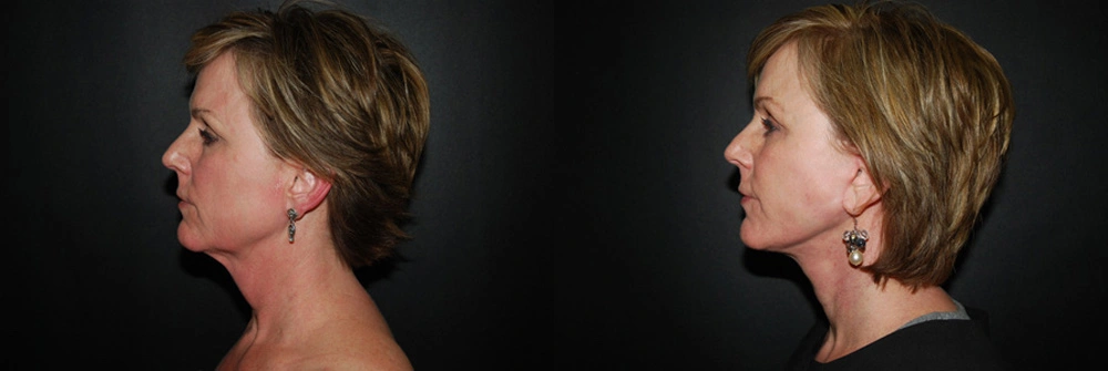 Real Patient Results in Newport Beach, CA. Preformed by Semira Bayait, MD, FACS.