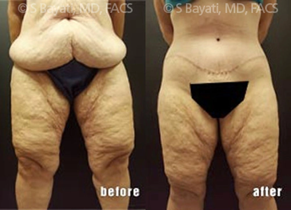 Real Patient Results in Newport Beach, CA. Preformed by Semira Bayait, MD, FACS.