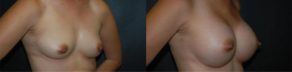 Real Patient Results in Newport Beach, CA. Preformed by Semira Bayait, MD, FACS.