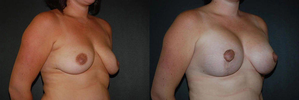 Real Patient Results in Newport Beach, CA. Preformed by Semira Bayait, MD, FACS.