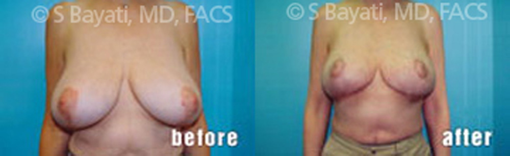 Real Patient Results in Newport Beach, CA. Preformed by Semira Bayait, MD, FACS.