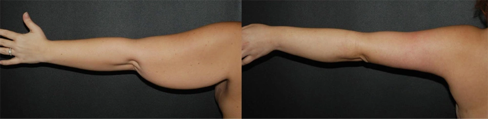 Real Patient Results in Newport Beach, CA. Preformed by Semira Bayait, MD, FACS.