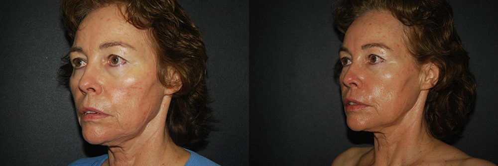 Real Patient Results in Newport Beach, CA. Preformed by Semira Bayait, MD, FACS.