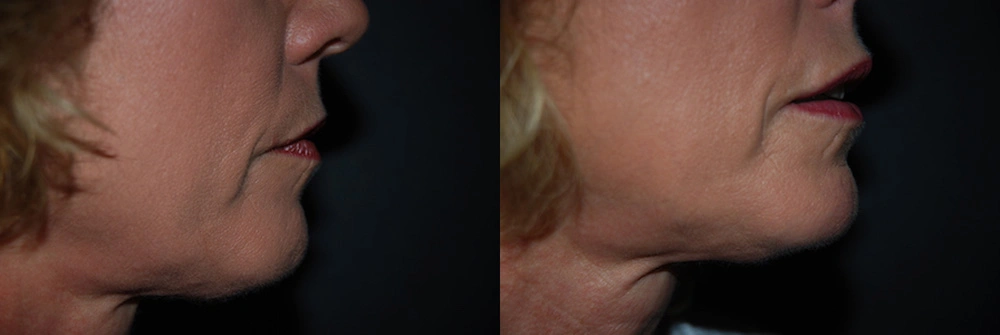 Real Patient Results in Newport Beach, CA. Preformed by Semira Bayait, MD, FACS.