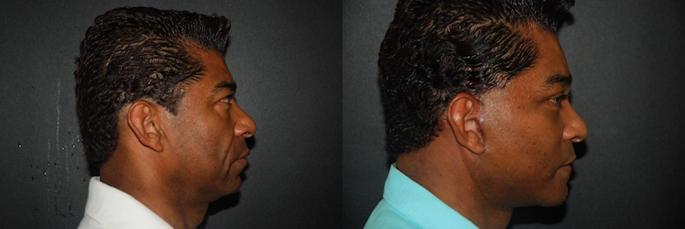 Real Patient Results in Newport Beach, CA. Preformed by Semira Bayait, MD, FACS.