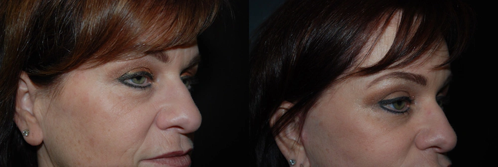 Real Patient Results in Newport Beach, CA. Preformed by Semira Bayait, MD, FACS.
