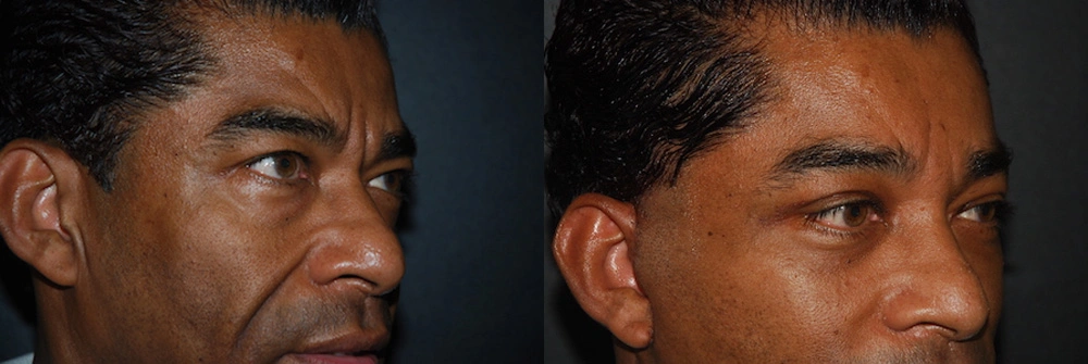 Real Patient Results in Newport Beach, CA. Preformed by Semira Bayait, MD, FACS.