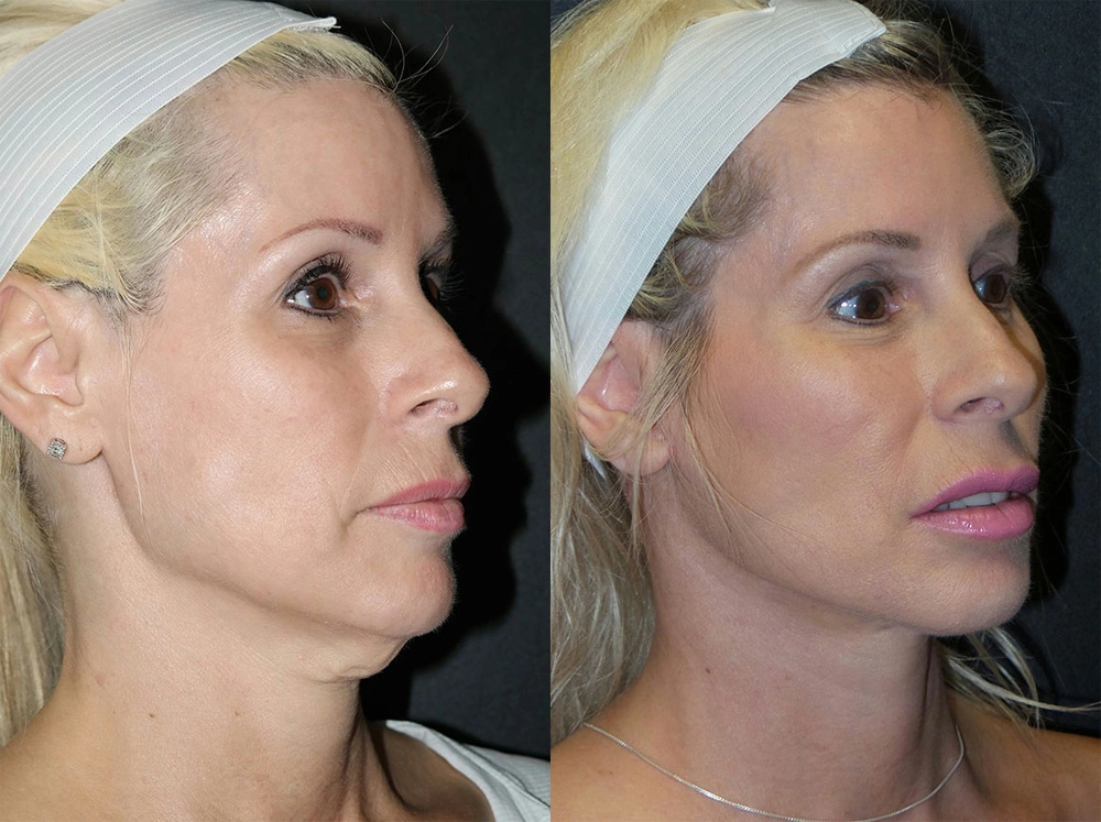 Real Patient Results in Newport Beach, CA. Preformed by Semira Bayait, MD, FACS.