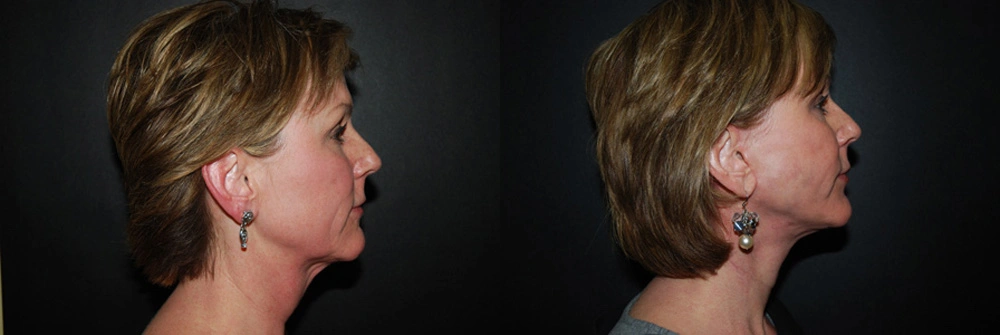 Real Patient Results in Newport Beach, CA. Preformed by Semira Bayait, MD, FACS.