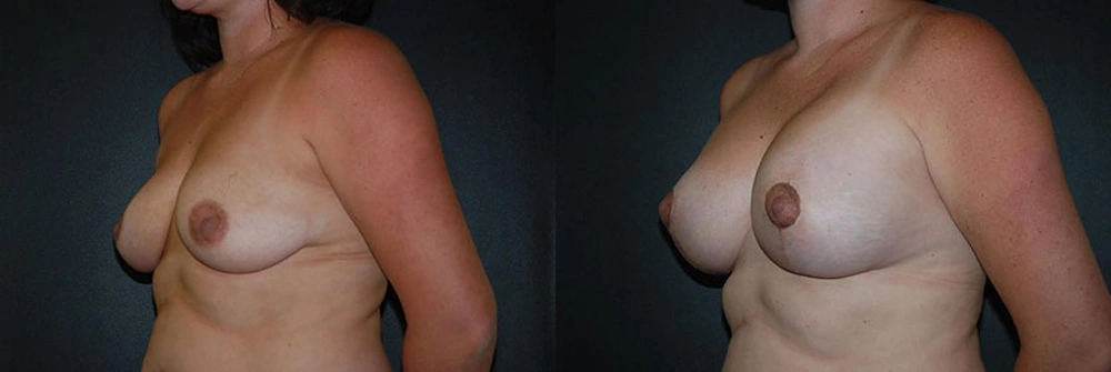 Real Patient Results in Newport Beach, CA. Preformed by Semira Bayait, MD, FACS.