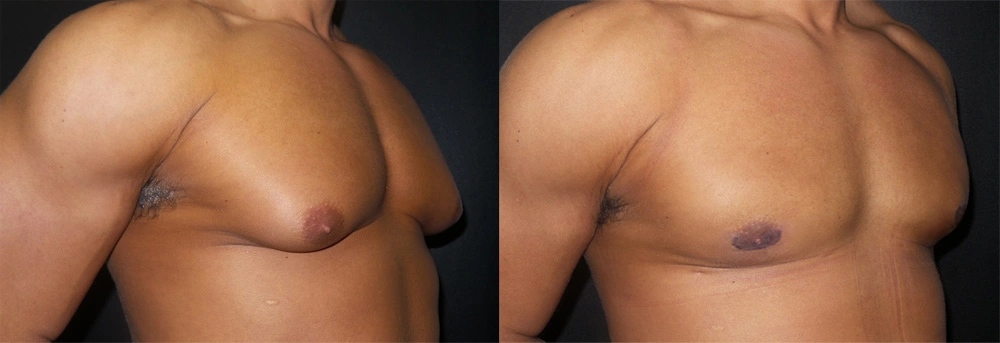 Real Patient Results in Newport Beach, CA. Preformed by Semira Bayait, MD, FACS.