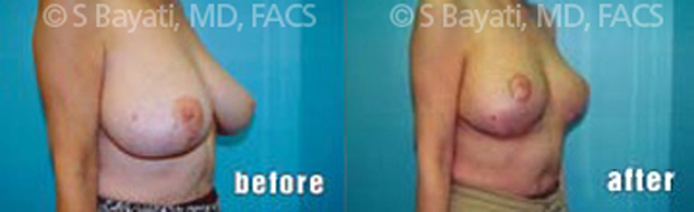 Real Patient Results in Newport Beach, CA. Preformed by Semira Bayait, MD, FACS.