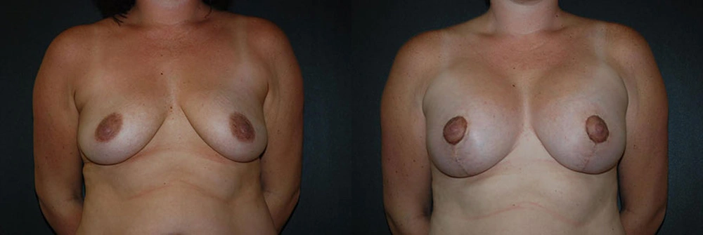 Real Patient Results in Newport Beach, CA. Preformed by Semira Bayait, MD, FACS.