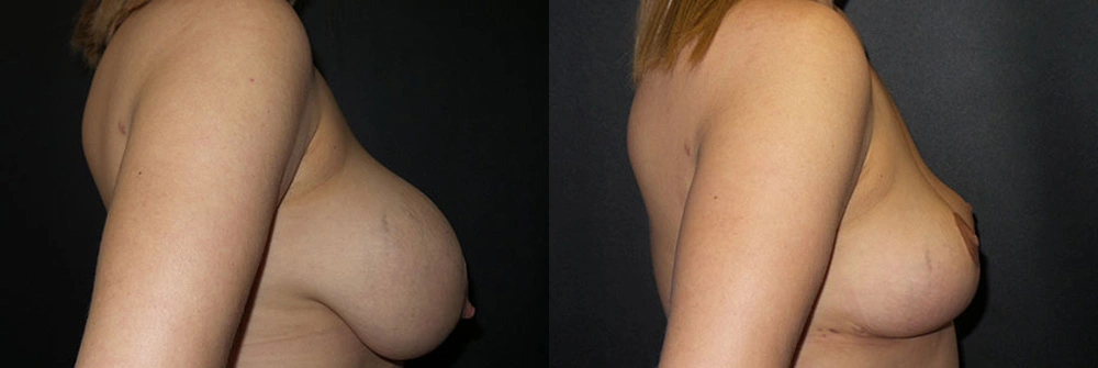 Real Patient Results in Newport Beach, CA. Preformed by Semira Bayait, MD, FACS.