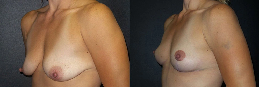 Real Patient Results in Newport Beach, CA. Preformed by Semira Bayait, MD, FACS.