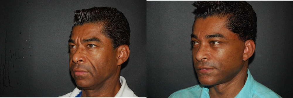 Real Patient Results in Newport Beach, CA. Preformed by Semira Bayait, MD, FACS.