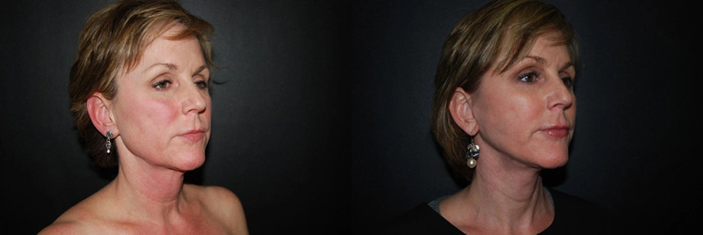 Real Patient Results in Newport Beach, CA. Preformed by Semira Bayait, MD, FACS.
