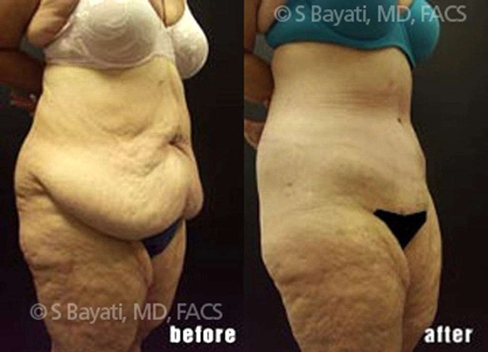Real Patient Results in Newport Beach, CA. Preformed by Semira Bayait, MD, FACS.