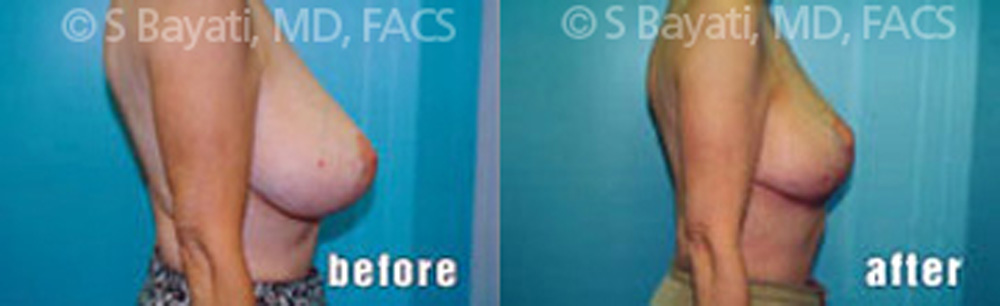 Real Patient Results in Newport Beach, CA. Preformed by Semira Bayait, MD, FACS.