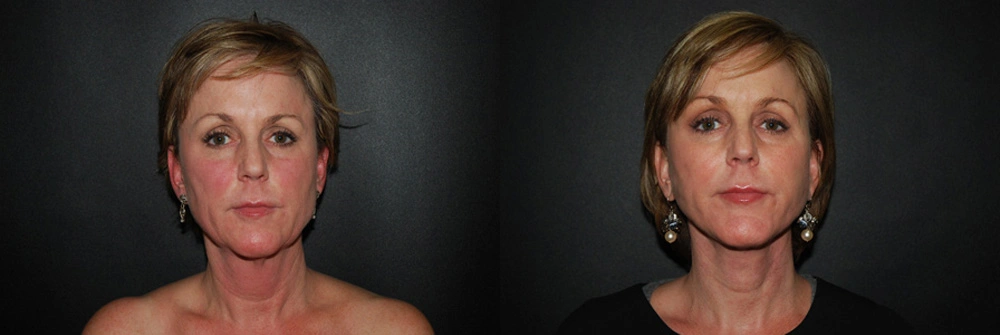 Real Patient Results in Newport Beach, CA. Preformed by Semira Bayait, MD, FACS.