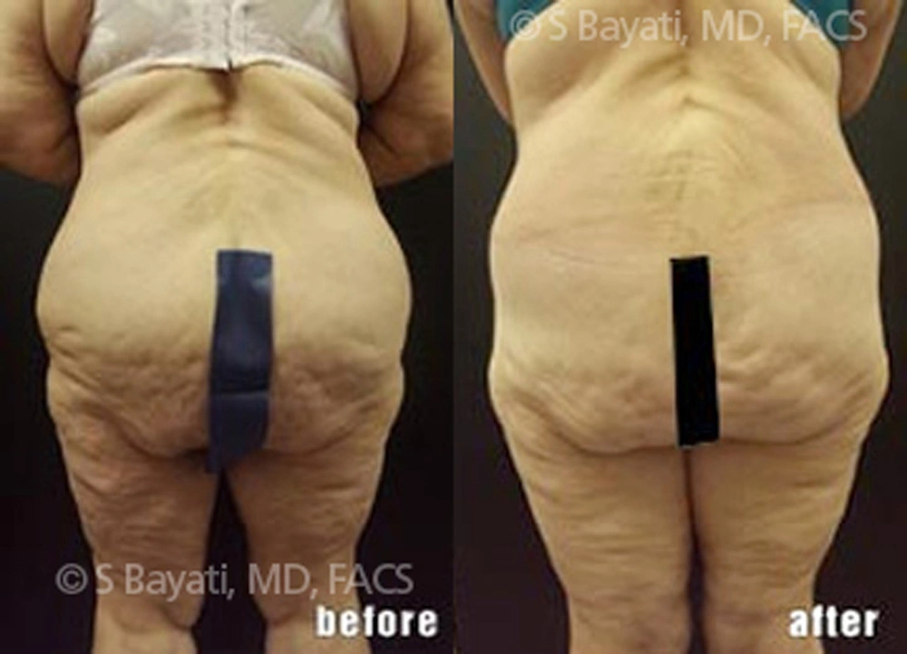 Real Patient Results in Newport Beach, CA. Preformed by Semira Bayait, MD, FACS.