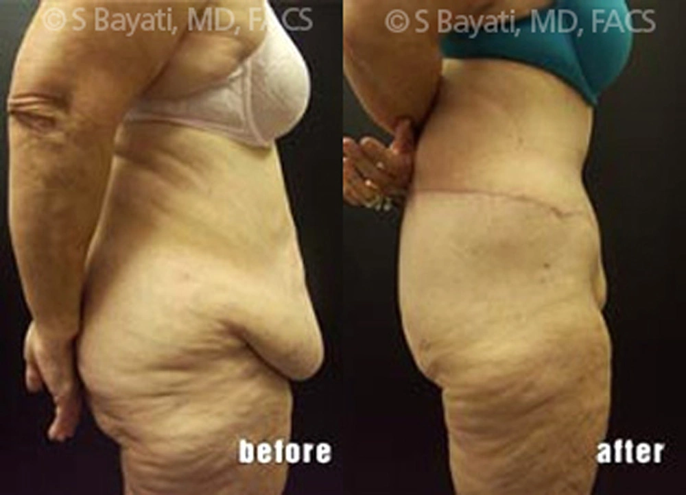 Real Patient Results in Newport Beach, CA. Preformed by Semira Bayait, MD, FACS.