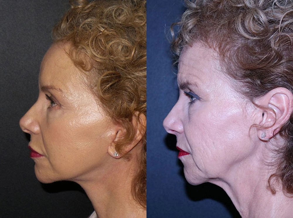 Real Patient Results in Newport Beach, CA. Preformed by Semira Bayait, MD, FACS.