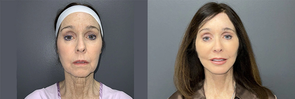 Real Patient Results in Newport Beach, CA. Preformed by Semira Bayait, MD, FACS.