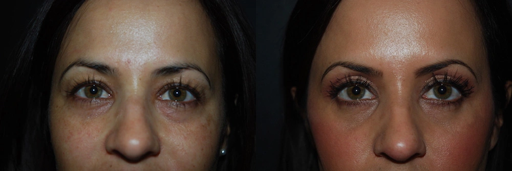 Real Patient Results in Newport Beach, CA. Preformed by Semira Bayait, MD, FACS.