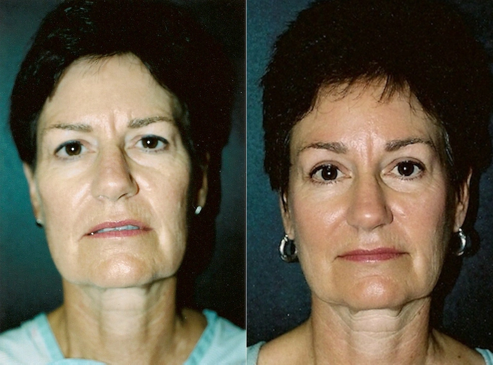 Real Patient Results in Newport Beach, CA. Preformed by Semira Bayait, MD, FACS.