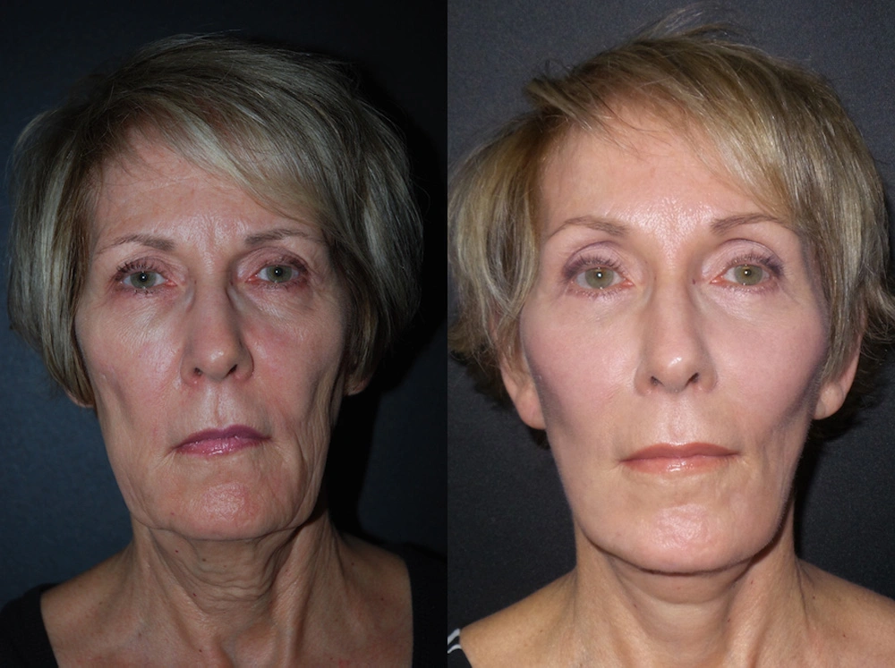 Real Patient Results in Newport Beach, CA. Preformed by Semira Bayait, MD, FACS.