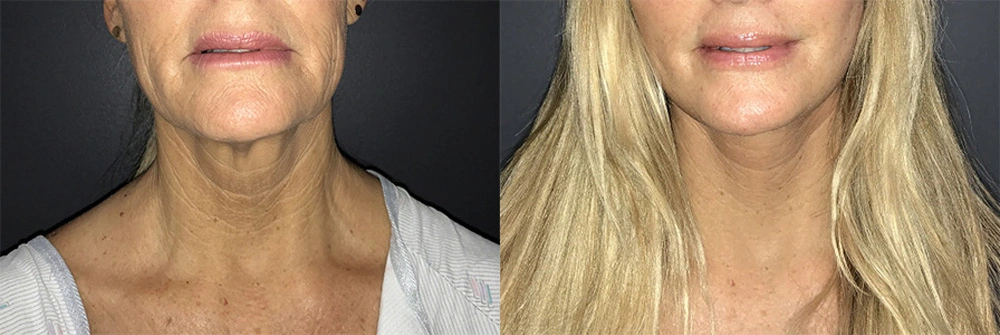Real Patient Results in Newport Beach, CA. Preformed by Semira Bayait, MD, FACS.
