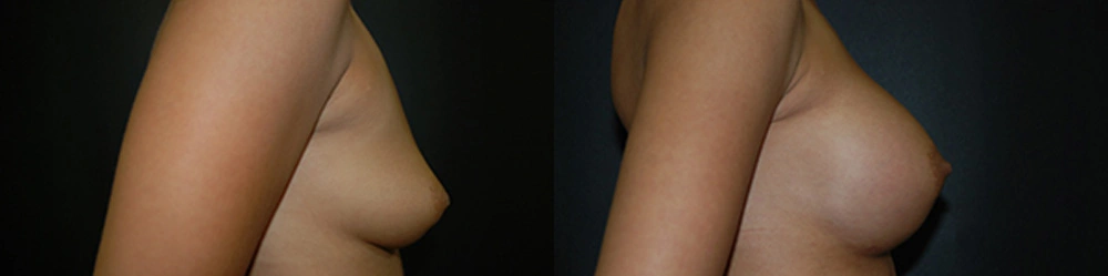 Real Patient Results in Newport Beach, CA. Preformed by Semira Bayait, MD, FACS.