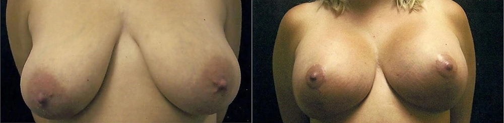 Real Patient Results in Newport Beach, CA. Preformed by Semira Bayait, MD, FACS.