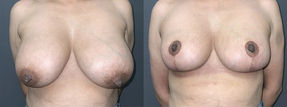 Real Patient Results in Newport Beach, CA. Preformed by Semira Bayait, MD, FACS.