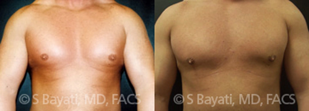 Real Patient Results in Newport Beach, CA. Preformed by Semira Bayait, MD, FACS.