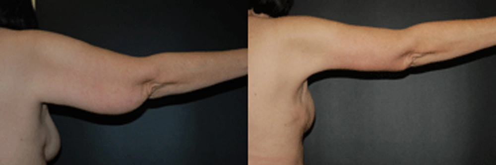 Real Patient Results in Newport Beach, CA. Preformed by Semira Bayait, MD, FACS.