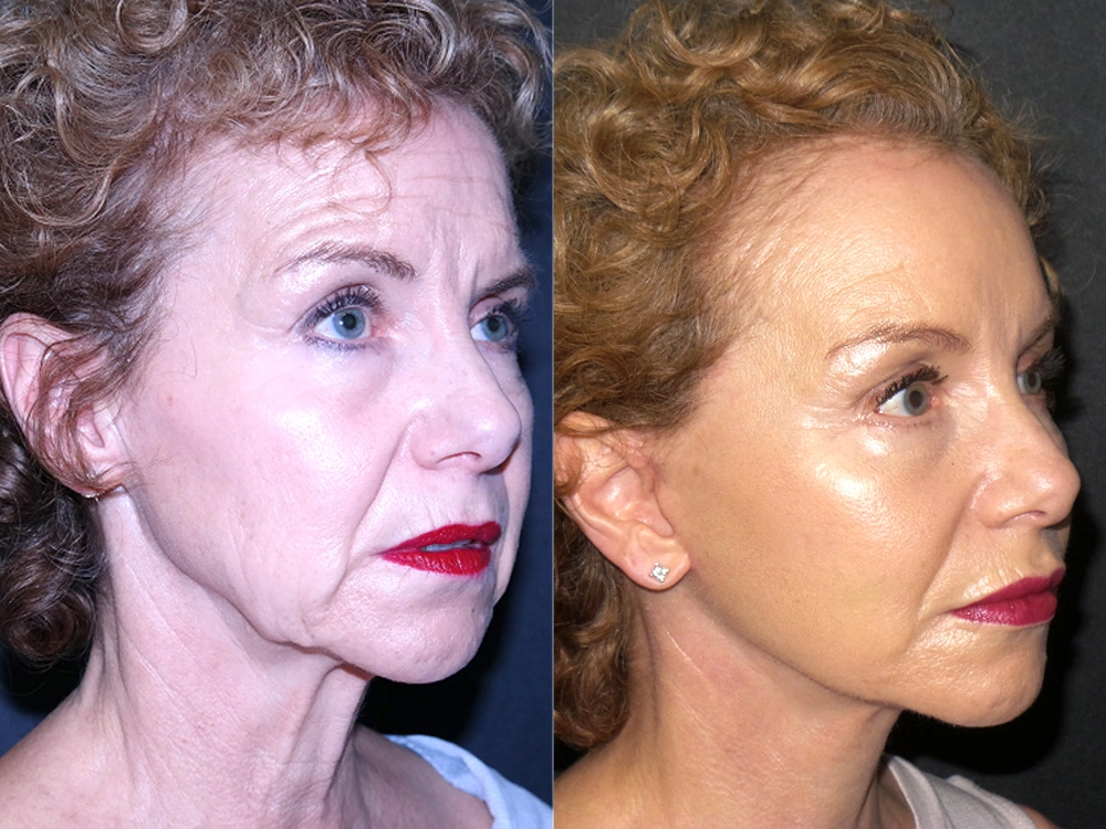 Real Patient Results in Newport Beach, CA. Preformed by Semira Bayait, MD, FACS.