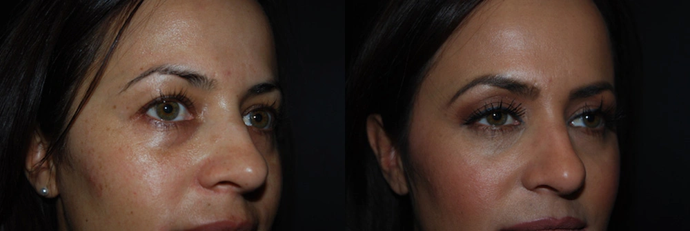 Real Patient Results in Newport Beach, CA. Preformed by Semira Bayait, MD, FACS.