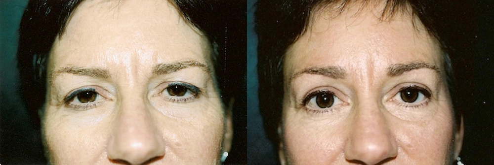 Real Patient Results in Newport Beach, CA. Preformed by Semira Bayait, MD, FACS.