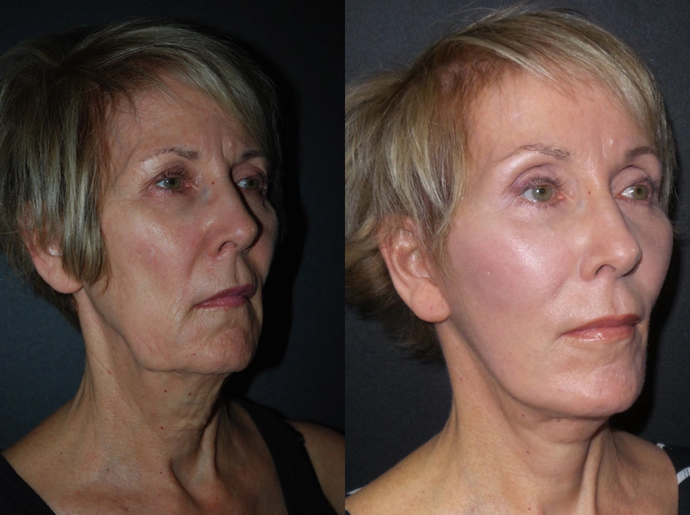 Real Patient Results in Newport Beach, CA. Preformed by Semira Bayait, MD, FACS.